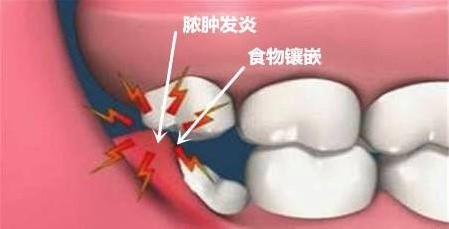 智齿到底应不应该拔,智齿到底要不要拔除