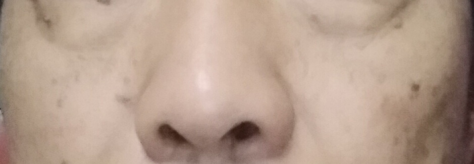 油溅到脸上有黑斑多久消失图片,脸上有老年黑斑怎么治