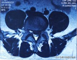 简单高效的治疗腰椎间盘突出,保守治疗腰椎间盘突出的方法