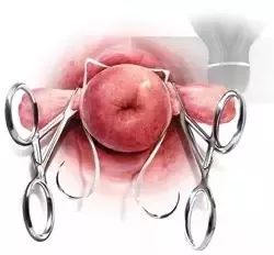 孕21周做宫颈环扎术成功率有多少,孕前腹腔镜宫颈环扎术过程及弊端