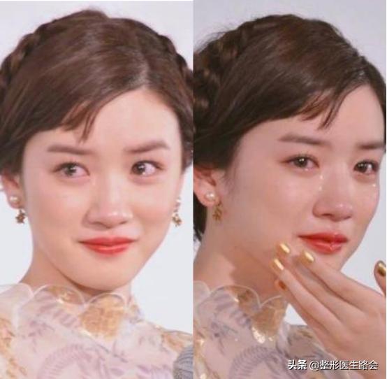 鼻头缩小后鼻孔里增生了,鼻头鼻翼缩小疤痕增生怎么办