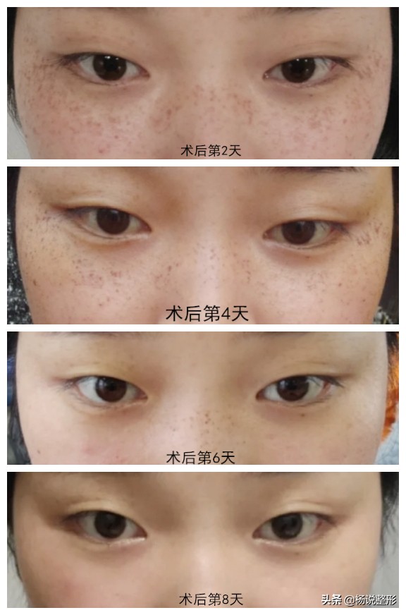 皮秒会反黑吗,皮秒反黑可以继续做皮秒吗