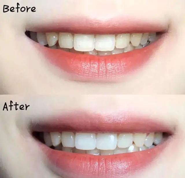 一张嘴臭牙齿就臭怎么办,一张嘴就口臭小妙招