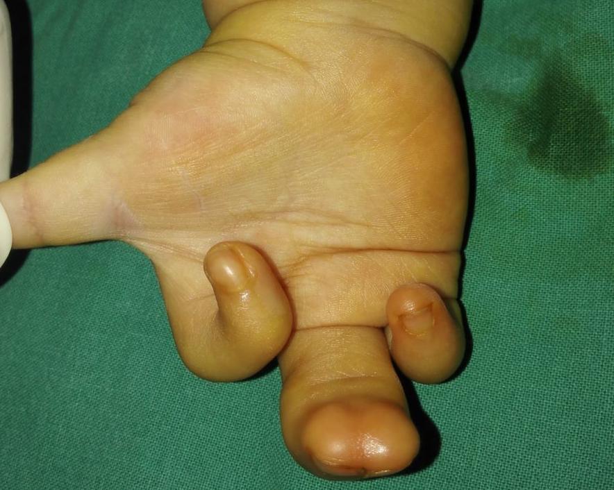 并指畸形免植皮案例,并指畸形