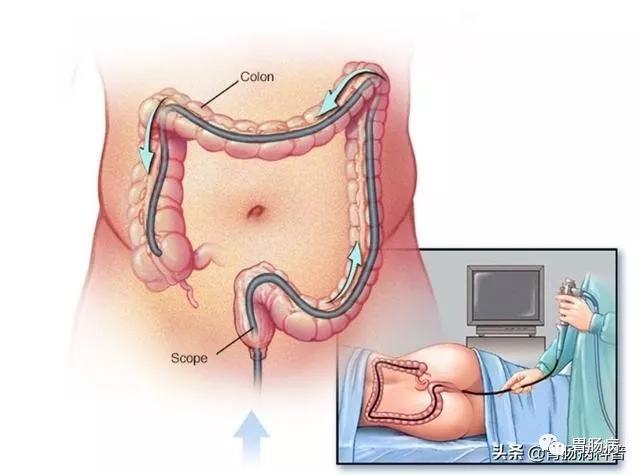 给大家科普胃肠镜,胃肠镜科普讲座