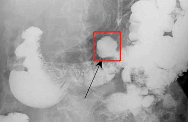 左下腹胀痛要警惕四种病,左下腹疼痛要警惕三大疾病