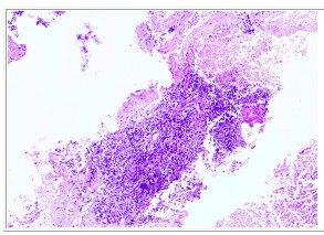 肺神经内分泌癌早期手术好吗,肺部神经内分泌肿瘤治疗