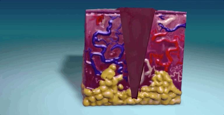 怎么恢复愈合伤口留下的疤痕,科普短片伤口是如何愈合的