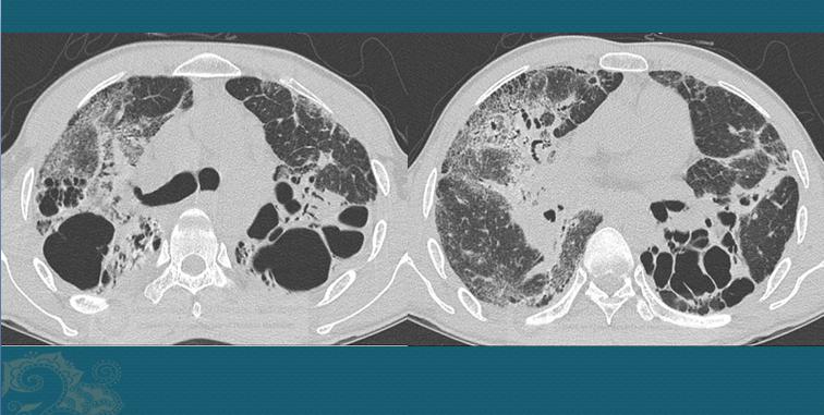 32岁肺部ct报告小结节7mm,28岁查出肺结节