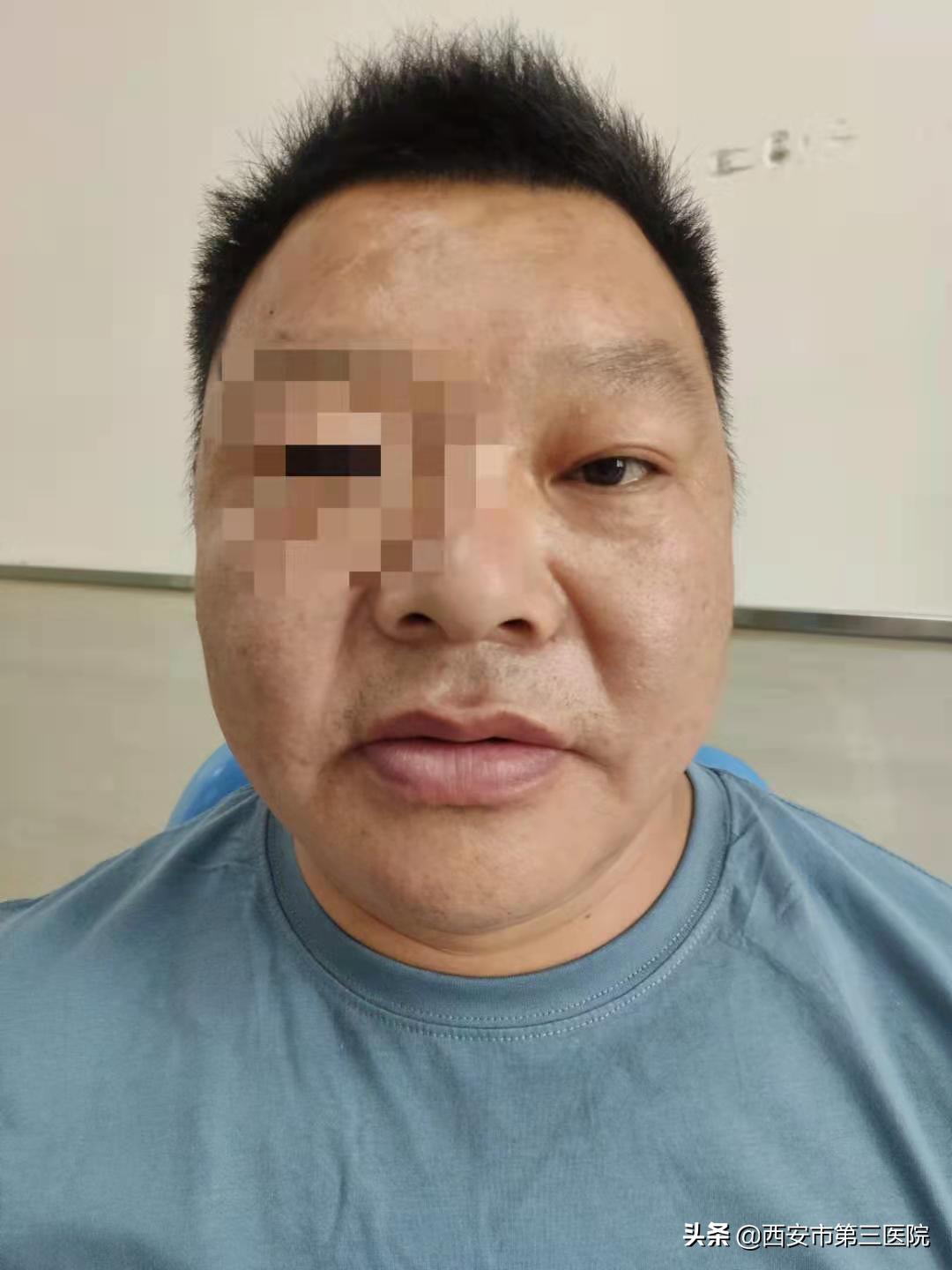 治愈鼻窦炎有好的方法么,鼻窦炎反复发作疼痛难以忍受