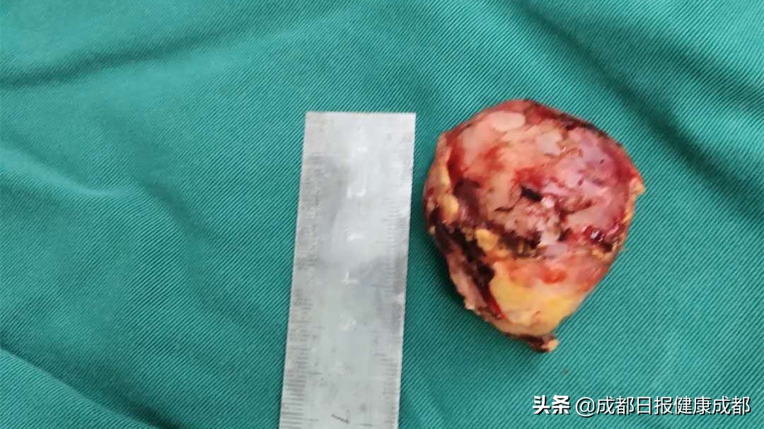 腹泻呕吐儿童,小孩4岁胃里长了个肿瘤12公分