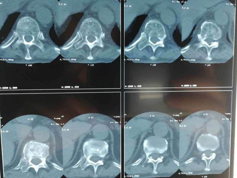 汉阴县中医医院微创手术治疗骨质疏松型骨折