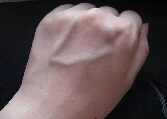 皮肤上的青筋,最近血管青筋比较明显