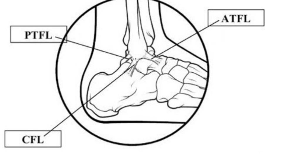 足踝扭伤疼痛位置图,踝足扭伤机制