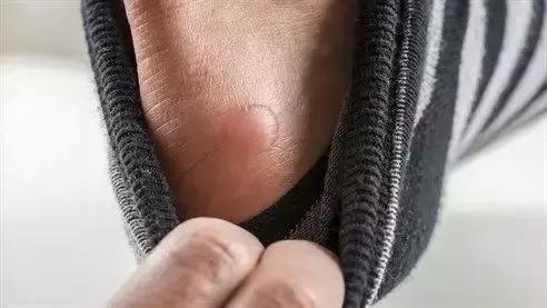 跑步跑出黑指甲怎么处理,跑步后脚趾甲充血变黑怎么办