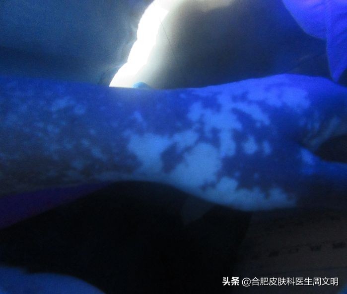 白癜风牛皮癣皮肤病为什么难治,白癜风治不好病情反复原因