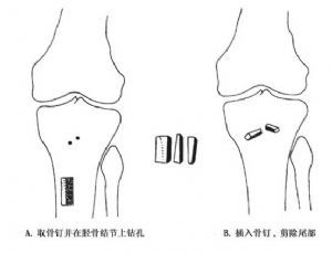 胫骨结节骨软骨病是怎么引起的,胫骨结节软骨炎不痛要治疗吗