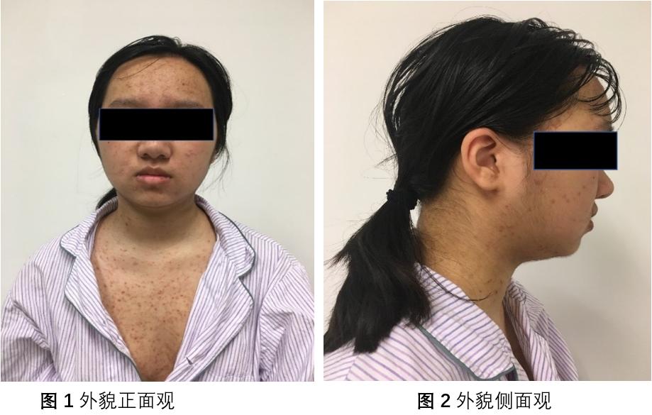 恶性肿瘤花季少女,花季少女面部恶性肿瘤