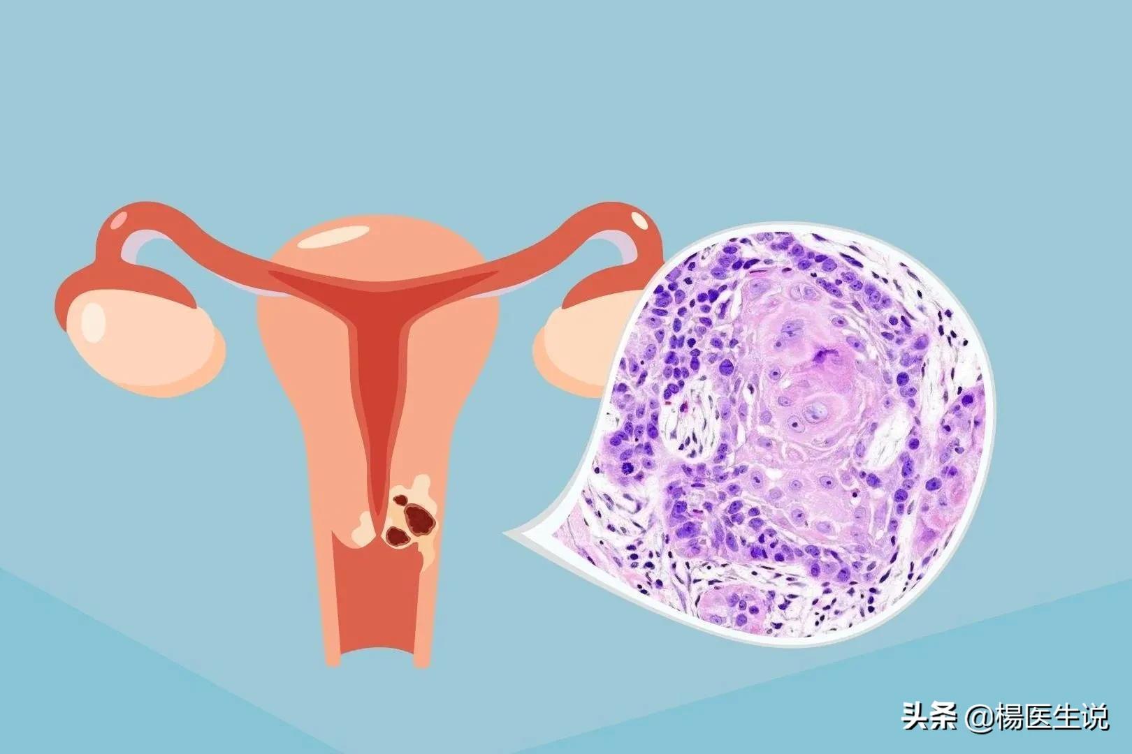 女性两癌筛查多少岁开始,女性两癌筛查多大年龄能查啊