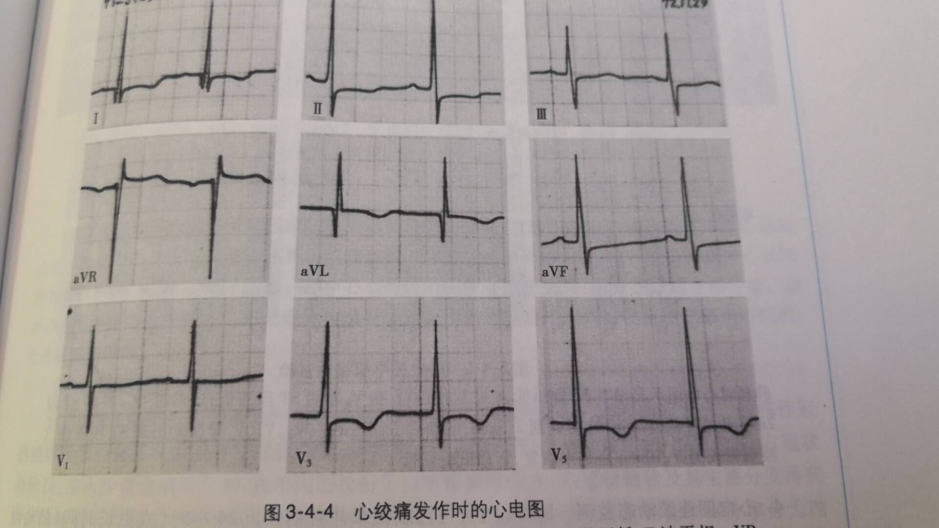体检心电图t波异常怎么办,心电图检查t波改变是心脏病吗