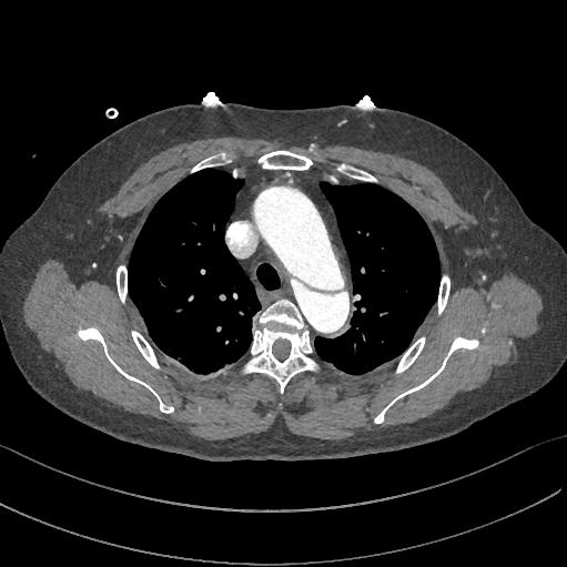 胸部Ct平扫能查出主动脉夹层吗,主动脉夹层cta影像图片解读