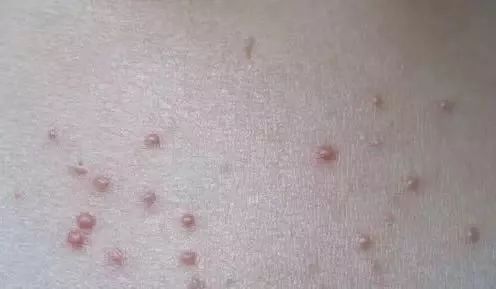 长了这么多年汗管瘤，你还以为是脂肪粒？