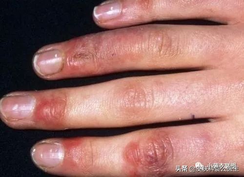 冻伤后痒痒是怎么回事,冻伤瘙痒