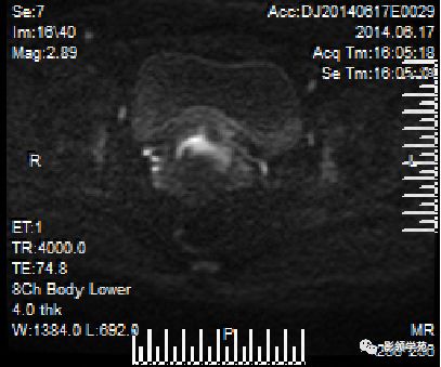 宫颈癌mri诊断,宫颈癌的mr扫描技术