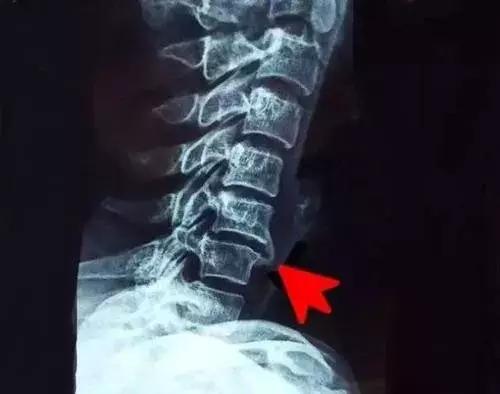 脚长骨刺最好的治疗方法,腰椎骨刺增生彻底治疗方法