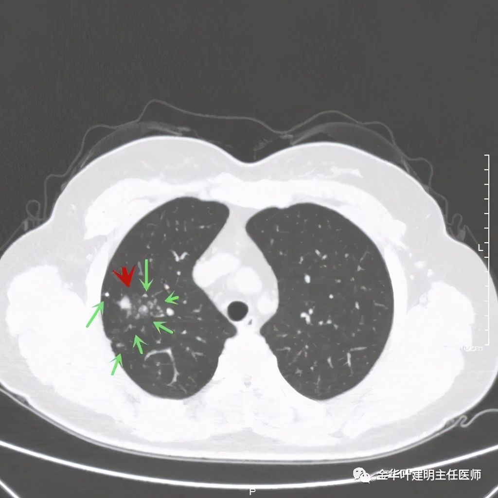 右上肺结节灶一般是什么癌,右上肺恶性肿瘤是肺癌吗