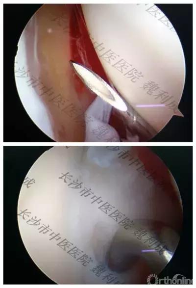 腱鞘囊肿除了手术还有什么办法,下颚有囊肿可以做穿刺手术