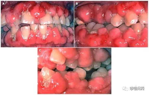 药物性牙龈增生是怎么回事,药物性牙龈肥大