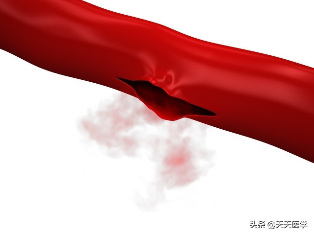 血友病的症状是什么,血友病的发病特点是