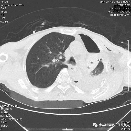 手术引起乳糜胸,有没有做了肺结节手术后是误诊的