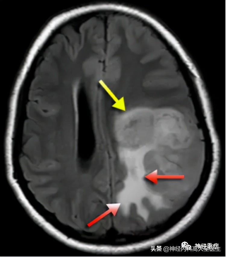 脑水肿是怎么形成,脑水肿和肾水肿的形成机制