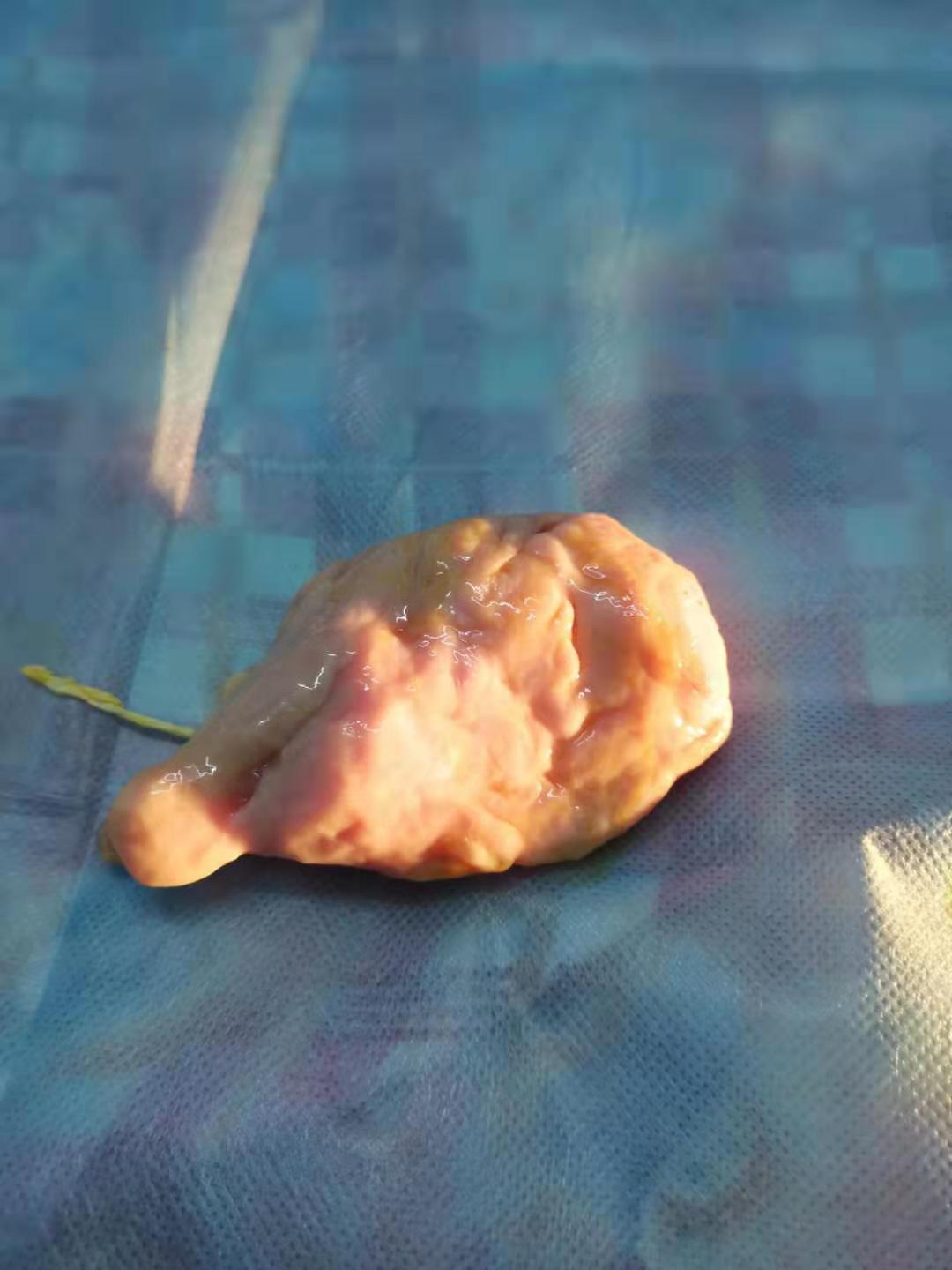 多发子宫肌瘤到底长在哪里了,子宫肌瘤一堆怎么治疗