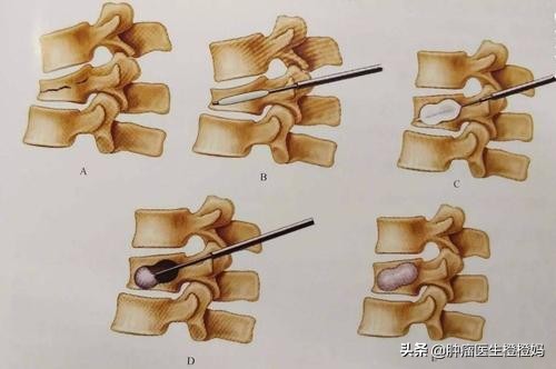 癌症骨转移可以把骨头拿掉吗,骨转移就是癌症晚期吗