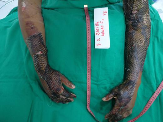 罗非鱼鱼皮治疗烧伤价格,罗非鱼鱼皮为什么对烧伤管用