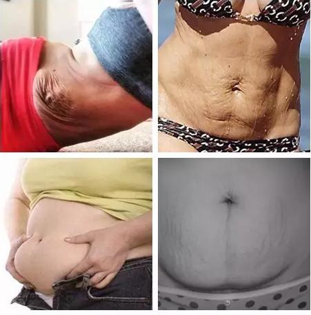 产后肚皮像橘子皮一样,产后肚子圆圆的像个球