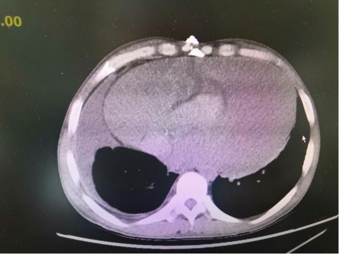 肾积液心包积液,肾移植有积液怎么回事