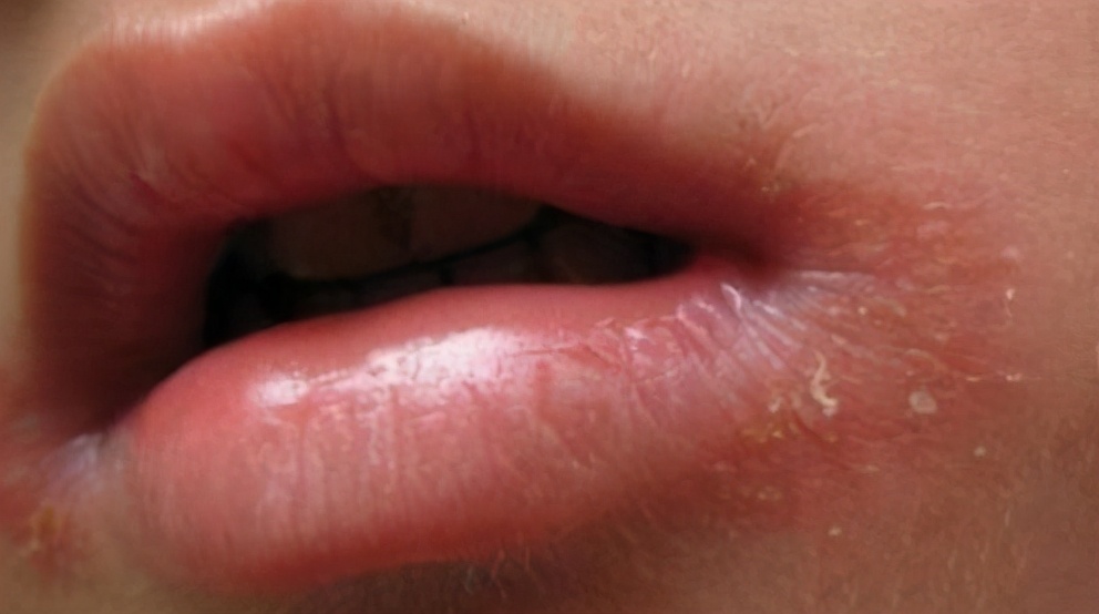 小孩上火烂嘴角最快治疗方法,因上火而烂嘴角吃什么药好呢