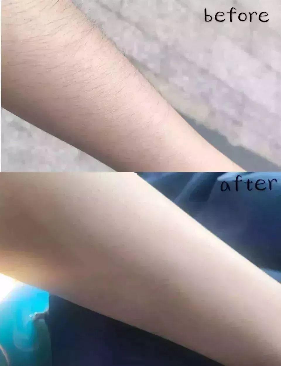 强烈推荐，永久脱毛，好评超多，拿走不谢