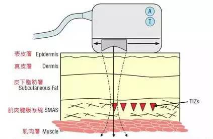 揭秘医美行业内幕：热玛吉、超声刀的“低价”3大陷阱