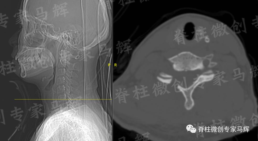 脊椎压迫神经做了微创术后腿麻疼,神经根损伤疼痛治疗