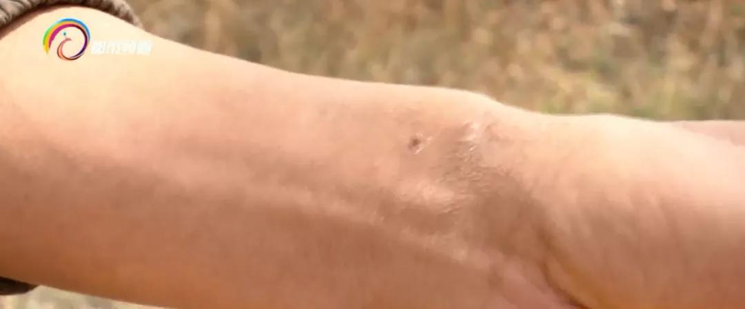 被广东的红火蚁咬了用什么药,多名村民被红火蚁咬伤