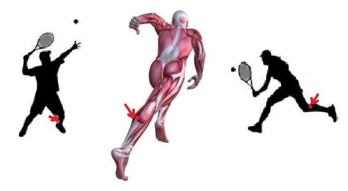 小腿后侧肌肉发力有疼痛感,小腿一发力肌肉就变形疼痛