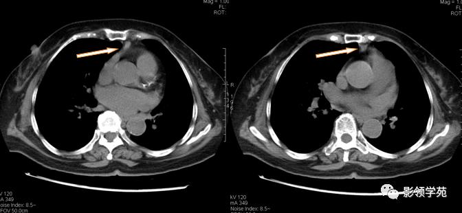 纵隔和肾上腺恶性肿瘤,纵隔性肿瘤位置图