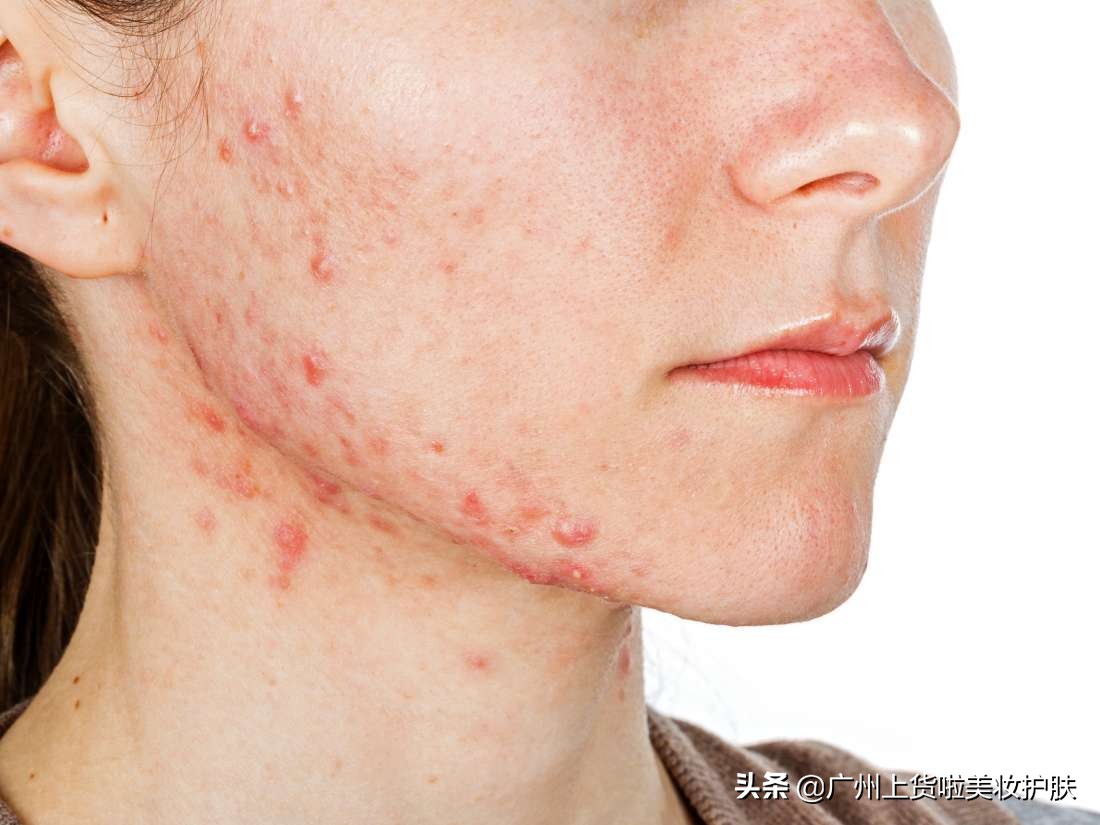 得了激素过敏性皮炎怎么办,得了激素性皮炎记住一停二忍三调