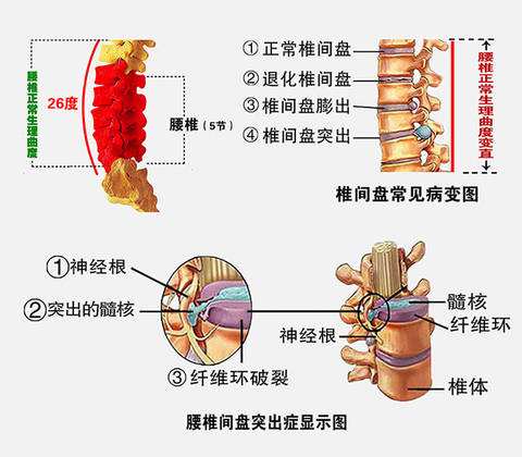 久坐后起身腰痛怎么回事,久坐导致的腰肌劳损比较痛怎么办