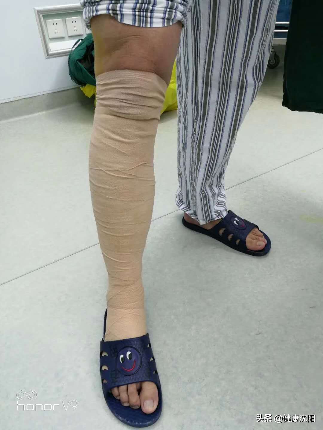 山东开展chiva治疗静脉曲张,chiva是微创治疗静脉曲张吗